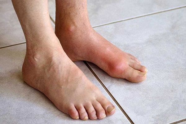 Bệnh Gout làm sưng các khớp chân